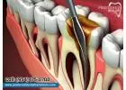 Expert Root Canal Services for Lasting Oral Health